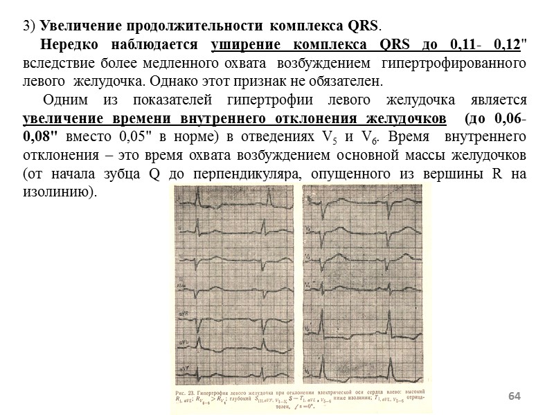 64 3) Увеличение продолжительности комплекса QRS. Нередко наблюдается уширение 64 3) Увеличение продолжительности комплекса QRS. Нередко наблюдается уширение
